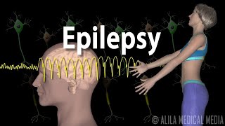 Epilepsy Types of seizures Symptoms Pathophysiology Causes and Treatments Animation [upl. by Ahsoet]