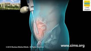 Inguinal Hernia Hindi  CIMS Hospital [upl. by Asiruam]