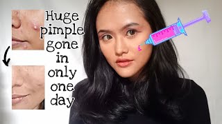 My acne injection story ⎮ Before and after ⎮ English ⎮ Vlog 45 [upl. by Ilwain]