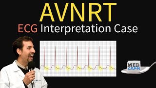 AV Nodal Reentry Tachycardia AVNRT on ECG  EKG [upl. by Medwin300]