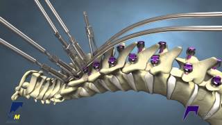 Correcting Kyphosis with the MESA Rail™ Deformity Spinal System [upl. by Tews]