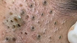 Big Cystic Acne Blackheads Extraction Blackheads amp Milia Whiteheads Removal Pimple Popping  8272 [upl. by Aneer788]