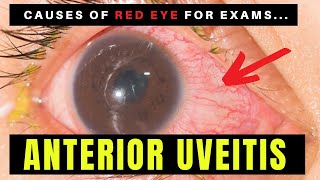 Causes of Red Eye  Part 2 ANTERIOR UVEITIS Iritis [upl. by Magdalen]