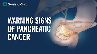 6 Warning Signs of Pancreatic Cancer [upl. by Dougall]