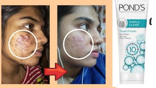 Ponds Pimple Clear Face Wash Review How to remove Pimple using Face wash  Effective Face Wash [upl. by Eiramllij]