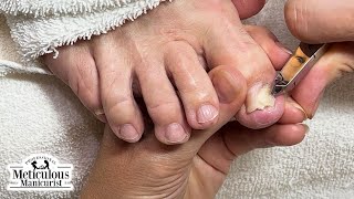 Tricky Ingrown Toenail Trim nails satisfying [upl. by Holtorf]