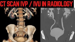 CT IVP IN RADIOLOGY kidney stone calculus ureter ivp hydronephrosis kidneydisease [upl. by Alger]