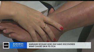 Researchers may have found what causes eczema itch [upl. by Ardied152]