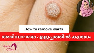 അരിമ്പാറ എങ്ങനെ കളയാം how to remove warts malayalam arimpara [upl. by Strait]