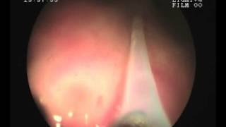 Video Tour Sigmoidoscopy and Polypectomy  wwwrkgastrolivercarecom [upl. by Suravart884]