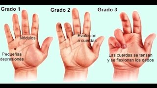 Contractura de Dupuytren  rehabilitacion fisica [upl. by Greeson]