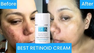 The Retinoid that Changed My Skin 1 Recommended Product Clinically Effective Retinoid Cream [upl. by Lareneg]