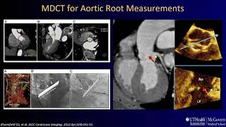 Echocardiography for Aortic Stenosis in the TAVR Era [upl. by Oirretno]