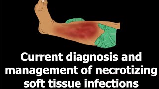 Current diagnosis and management of necrotizing soft tissue infections [upl. by Arihppas]