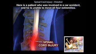 Spinal Cord Injury Detailed  Everything You Need To Know  Dr Nabil Ebraheim [upl. by Ahsaenat493]