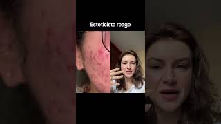 Esteticista reage a adesivo hidrocoloide [upl. by Angelia]