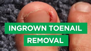 Ep 59 Ingrown Toenail Removal Procedure  The Scope [upl. by Irafat]