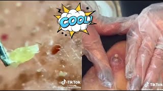 Ultimate Satisfying Acne Removal Compilation Best Pimple Pops Blackheads and Cysts [upl. by Chabot]