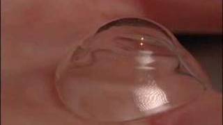 Scleral Contact LensesMayo Clinic [upl. by Notnyw36]