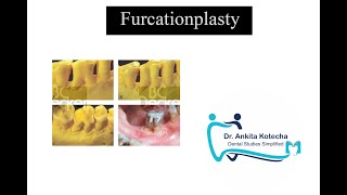 FURCATIONPLASTYTREATMENT OF FURCATION INVOLVEMENTPERIODONTICSDR ANKITADENTAL STUDIES SIMPLIFIED [upl. by Anderegg456]