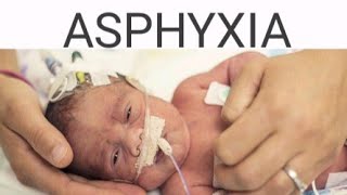 Asphyxia  Birth Asphyxia [upl. by Blynn]