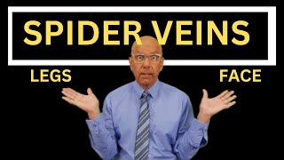 5 Ways To Treat Spider Veins with INSTANT RESULTS  Chris Gibson [upl. by Etnuahs428]