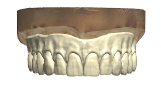 Prettau Implant screw retained bridge 2015 [upl. by Annwahsal734]