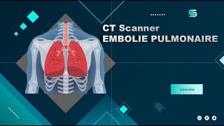 CT Scanner EMBOLIE PULMONAIRE  Partage de pratiques [upl. by Oileduab]