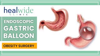 Gastric balloon  Endoscopic Gastric Balloon  nonsurgical weightloss procedure  in TURKEY [upl. by Longwood]