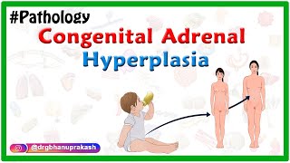 Congenital adrenal hyperplasia  Etiology Pathophysiology Clinical features Diagnosis Treatment [upl. by Talia]