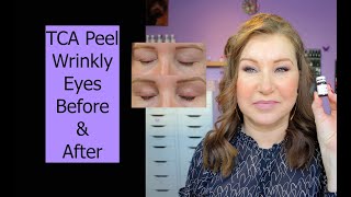 TCA Peel for Eyelids  Before amp After Demo  WrinklyMature Eyes [upl. by Fredelia]