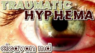 Cleavon MD  Traumatic Hyphema [upl. by Akirehs309]