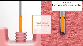 TrapLock Trap lock Bone Marrow Trephine Biopsy Needle Method of use [upl. by Mulry]