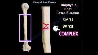 Humeral Shaft Fracture  Everything You Need To Know  Dr Nabil Ebraheim [upl. by Atsyrhc71]