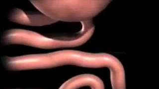 gastric bypass animation [upl. by Arba]