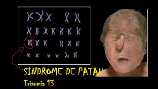 Síndrome de Patau Trisomía 13 [upl. by Aelahc139]