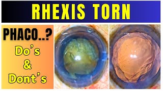 Rhexis is torn Dos and Donts for Phacoemulsification Principles to Follow [upl. by Furlani845]