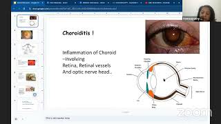 Homoeopathy for Choroiditis [upl. by Anaehr182]