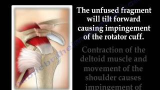 The Acromion Os Acromiale  Everything You Need To Know  Dr Nabil Ebraheim [upl. by Nohsed129]