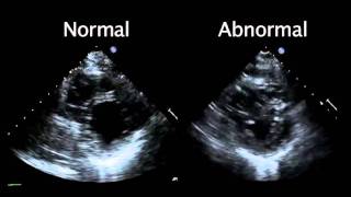 Echocardiogram from the Patient Compared with That from a Normal Control  NEJM [upl. by Imnubulo]