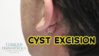 Stubborn Reoccurring Cyst Needs Removal [upl. by Onaimad]