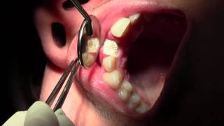 Bone Grafting 8 Site Membrane Removal at 28 Days [upl. by Ykcor363]