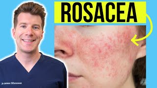 Doctor explains ROSACEA  Skin Condition  Causes Treatment and more [upl. by Borlase]