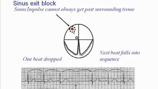 ECG Sinus Exit Block [upl. by Orgell]