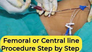 Femoral or Central Line Procedure Step by Step  Dr Subodh [upl. by Aynotal]