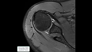 Shoulder MRI Labral Tear [upl. by Nnylaf]