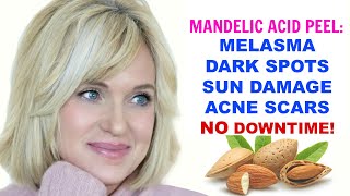 MANDELIC ACID PEEL MELASMA DARK SPOTS HYPERPIGMENTATION SUN DAMAGE amp ACNE Skincare Over 50 [upl. by Hpesojnhoj]