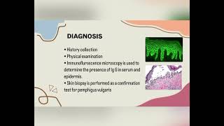 Pemphigus vulgaris [upl. by Eberto]