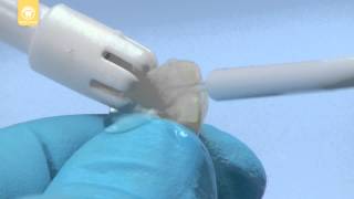 Veneer Cementation with PermaShade LC [upl. by Novelc454]