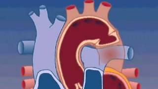 Coarctation of the Aorta [upl. by Iow]